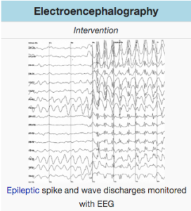 https://en.m.wikipedia.org/wiki/Electroencephalography