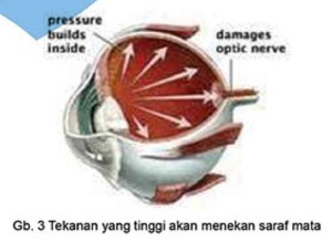 Glaukoma merusak struktur/fungsi saraf mata mnyebabkan gangguan penglihatan scr tetap bahkan kebutaan permanen 
