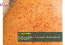 Septikemia, Multiplikasi Bakteri dalam Darah