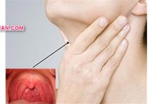 Varian Obat Sariawan di Tenggorokan yang Ampuh dan Manjur Obat Sariawan di Tenggorokan