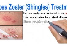 Herpes Zoster: Pengertian, Gejala, Risiko, Langkah Pengobatan dan Pencegahan Herpes Zoster - Pengertian Gejala Risiko Langkah Pengobatan dan Pencegahan