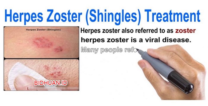Herpes Zoster: Pengertian, Gejala, Risiko, Langkah Pengobatan dan Pencegahan