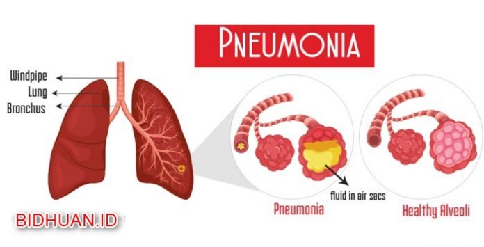 Paru Paru Basah (Pneumonia) - Penyebab Gejala dan Cara Pencegahan