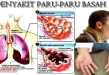 Penyakit Paru-paru Basah: Pengertian, Cara Mencegah dan Metode Penyembuhan Penyakit Paru-paru Basah - Pengertian Cara Mencegah dan Metode Penyembuhan