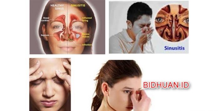 Penyakit Sinusitis - Gejala Penyebab Akibat Bahaya dan Pengobatannya