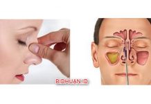 Polip Hidung: Penyebab, Gejala dan Pilihan Obat Tradisional Selain Operasi Polip Hidung - Penyebab Gejala dan Pilihan Obat Tradisional Selain Operasi