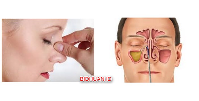 Polip Hidung: Penyebab, Gejala dan Pilihan Obat Tradisional Selain Operasi