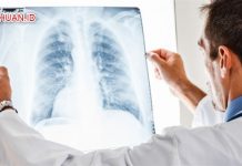 Gejala Paru-Paru Basah (Pneumonia): 20 Gejala Umum Dari Penyakit Paru-Paru Basah Lengkap Gejala Paru-Paru Basah (Pneumonia) - 20 Gejala Umum Dari Penyakit Paru-Paru Basah Lengkap