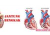 Pembengkakan Jantung - 6 Ciri dan 5 Penyebab Tandanya Serta 5 Resiko Jantung Bengkak