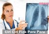 Flek Paru-Paru - Penyebab Cara Mencegah dan Gejala Penyakit Paru
