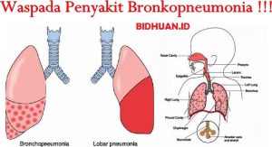 Bronkopneumonia: Gejala, Penyebab Dan Pengobatannya - Berbagi Cerita ...