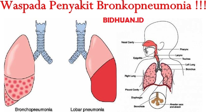 Bronkopneumonia Definisi Epidemiologi Penyebab Patofi