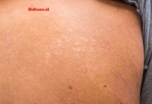 10 Obat Panu Terbaik yang Manjur Hilangkan Panu Obat Panu