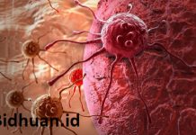 Perbedaan Tumor dan Kanker : Penjelasan dan Contoh